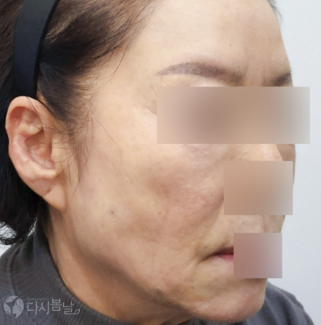 嘴角玻尿酸填充AFTER 嘴角玻尿酸填充AFTER