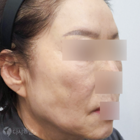 嘴角玻尿酸填充BEFORE