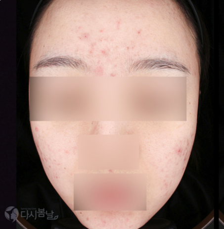 皮膚管理BEFORE 皮膚管理BEFORE