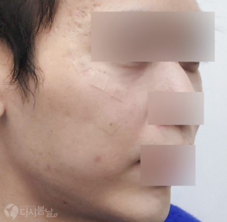 眼下&臉頰玻尿酸填充 AFTER