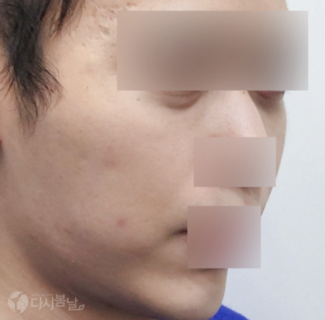 眼下&臉頰玻尿酸填充BEFORE 眼下&臉頰玻尿酸填充BEFORE