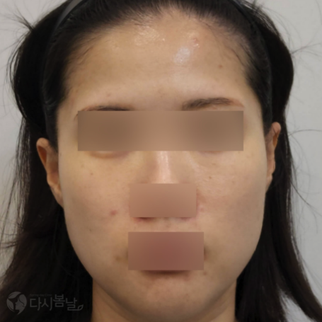 01.玻尿酸填充-正臉BEFORE