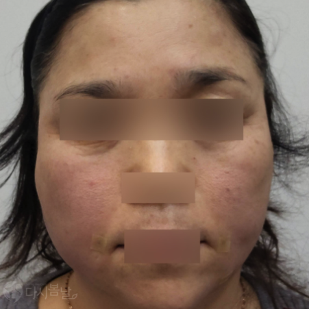 02.法令紋填充(5cc) & TESS拉提術 (4 條)-正臉after