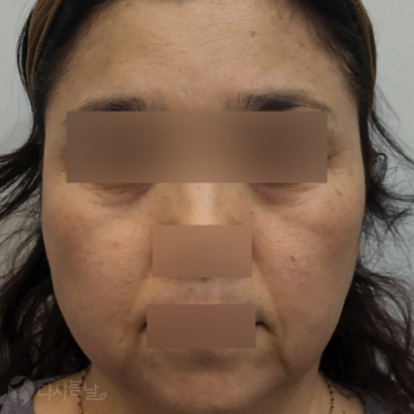 02.法令紋填充(5cc) & TESS拉提術 (4 條)-正臉before