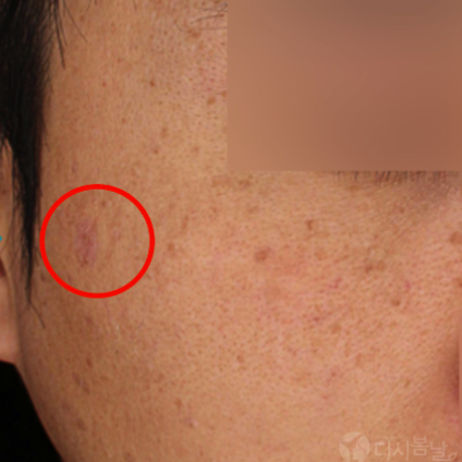 03.淨膚雷射-近拍AFTER