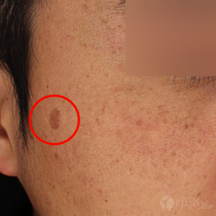 03.淨膚雷射-近拍BEFORE