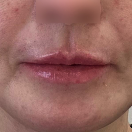 04.唇部玻尿酸填充 A