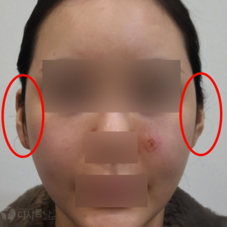 06.耳部玻尿酸填充 正面A