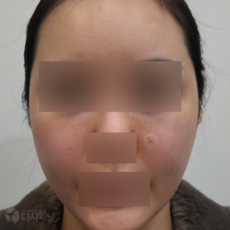 06.耳部玻尿酸填充 正面B