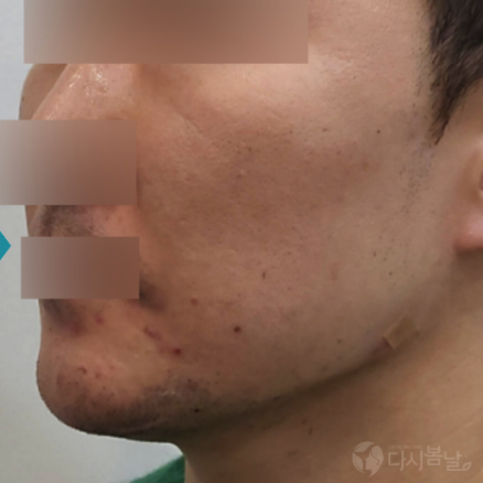 07.下巴玻尿酸填充 右側A