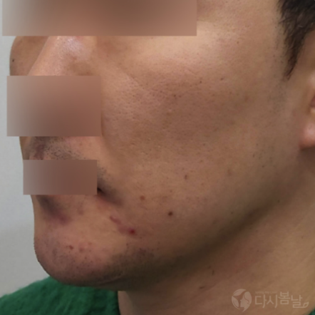 07.下巴玻尿酸填充 右側B