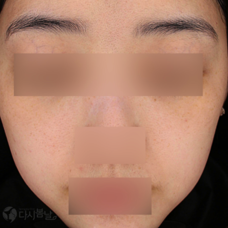 08.PicoSure Pro 鉑金蜂巢皮秒 正面A