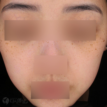 08.PicoSure Pro 鉑金蜂巢皮秒 正面B