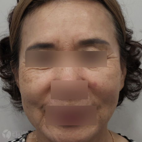 09.全臉玻尿酸填充 正臉A