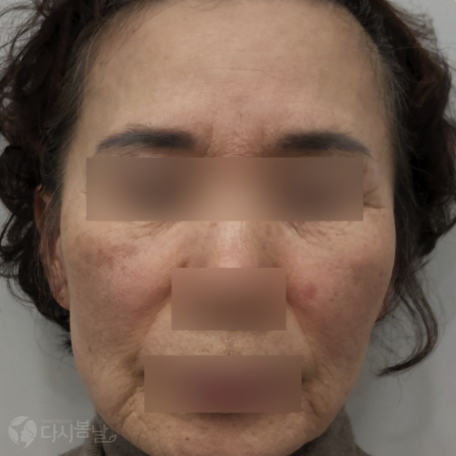 09.全臉玻尿酸填充 正臉B