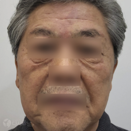 10.PicoSure Pro 鉑金蜂巢皮秒＋柔膚雷射 正臉A