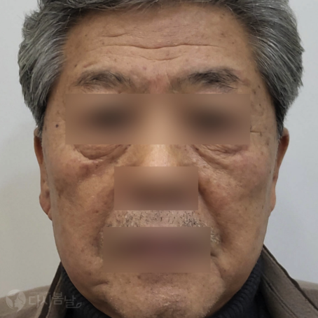 10.PicoSure Pro 鉑金蜂巢皮秒＋柔膚雷射 正臉B