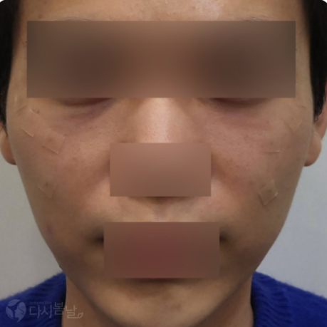 11.前頰(2cc)＋眼下(0.5cc)玻尿酸填充 正臉A