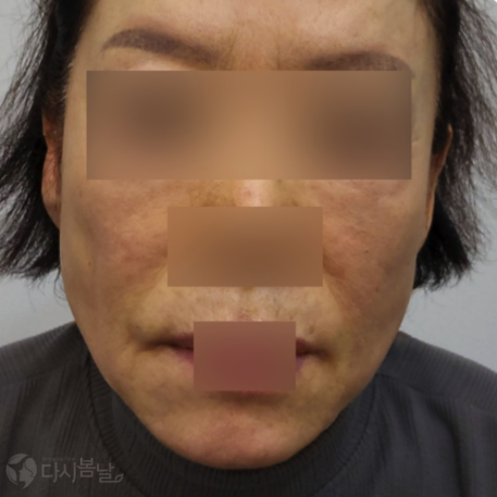 12.唇周(6cc)玻尿酸填充正臉A