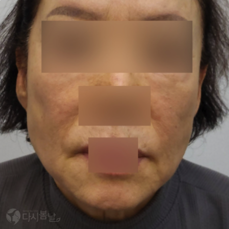 12.唇周(6cc)玻尿酸填充正臉B