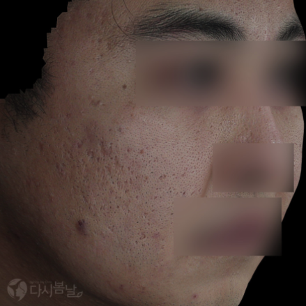 14.Mirajet 無針注射 左臉B