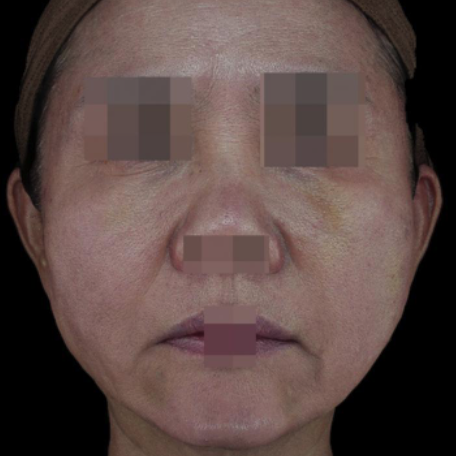 15.全臉玻尿酸填充＋線雕拉提 正臉A