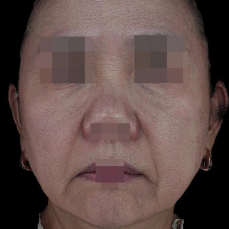 15.全臉玻尿酸填充＋線雕拉提 正臉B