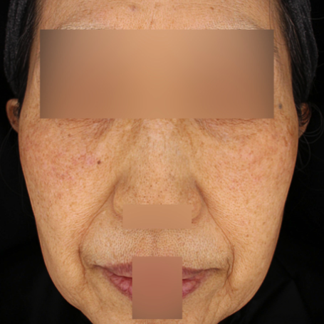 16.PicoSure Pro 鉑金蜂巢皮秒＋柔膚雷射 正臉A