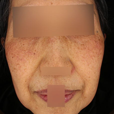 16.PicoSure Pro 鉑金蜂巢皮秒＋柔膚雷射正臉B