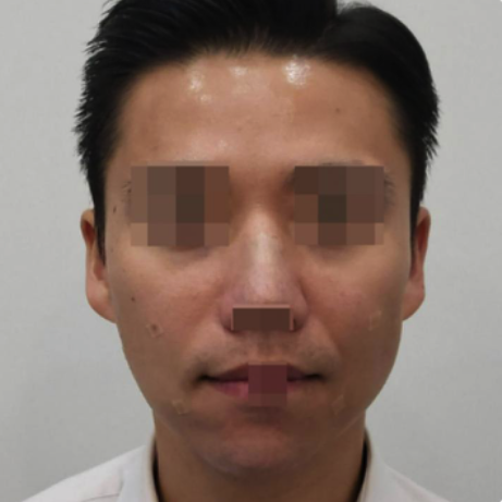 17.全臉玻尿酸填充(11cc)+HIKO 韓式埋線隆鼻 正面A