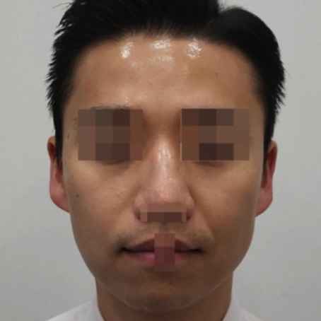 17.全臉玻尿酸填充(11cc)+HIKO 韓式埋線隆鼻 正面B