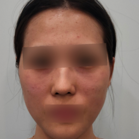 18.眼下＋臉頰玻尿酸填充正臉A