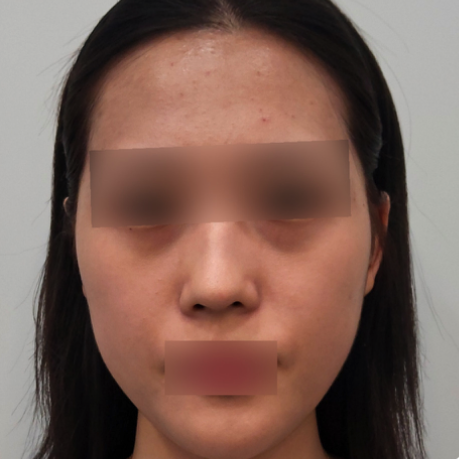 18.眼下＋臉頰玻尿酸填充正臉B